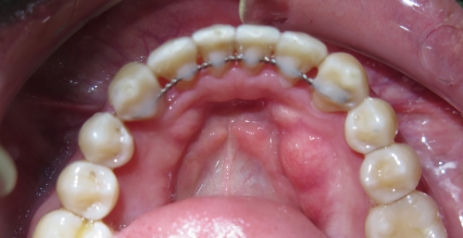 Close up of straightened teeth after Invisalign