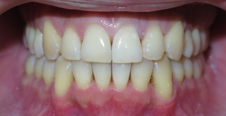 Close up of straightened teeth after Invisalign