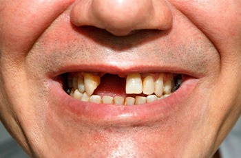 Man smiling to reveal his missing teeth