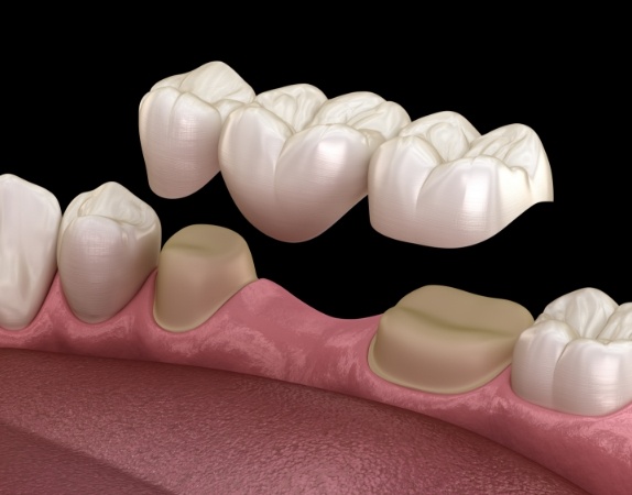 Illustrated dental bridge replacing a missing tooth