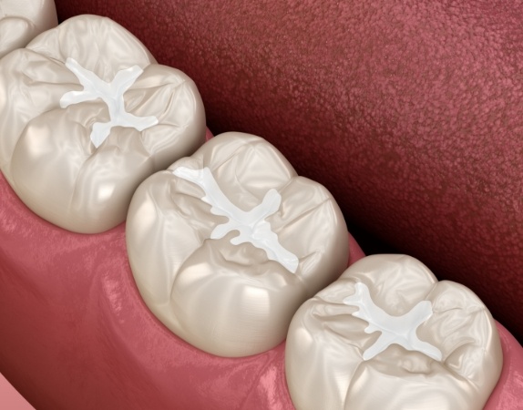 Illustrated row of teeth with dental sealants