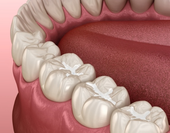Illustrated row of teeth with white fillings