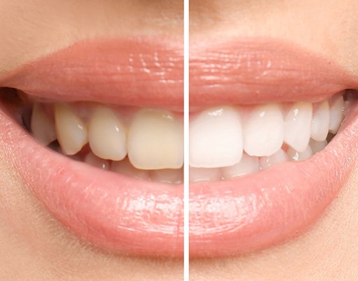 Closeup of a smile that’s half whitened
