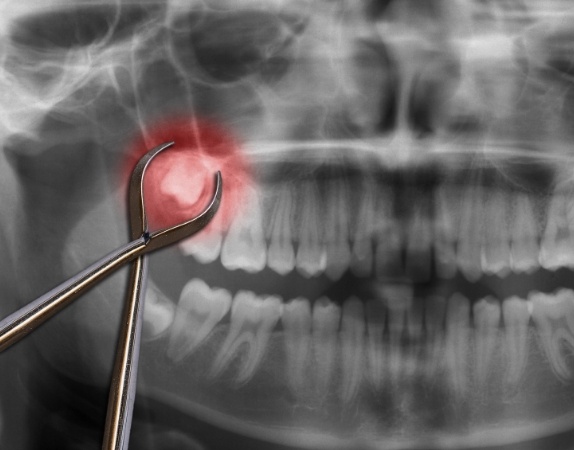 Dental forceps in front of a dental x ray with wisdom tooth highlighted red
