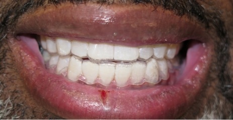Close up of brighter teeth after Zoom teeth whitening