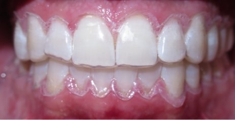 Close up of brighter teeth after Zoom teeth whitening