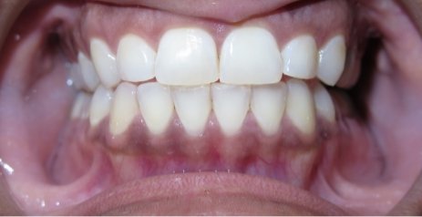 Close up of brighter teeth after Zoom teeth whitening