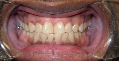 Close up of discolored teeth