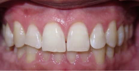 Close up of discolored teeth