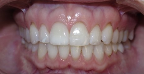 Close up of discolored teeth