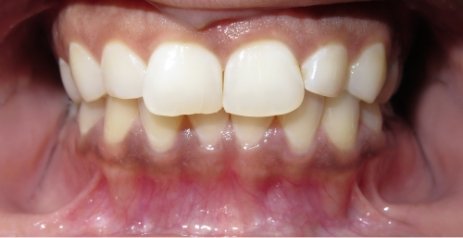 Close up of discolored teeth