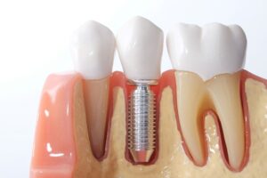 Shiny model dental implant